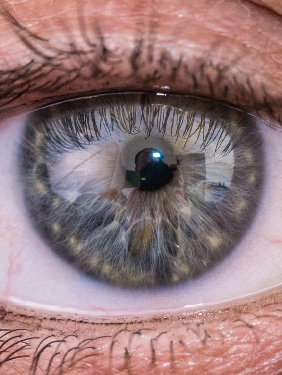 Toric Lenses for Astigmatism