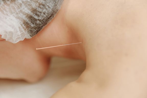 How does acupuncture work?