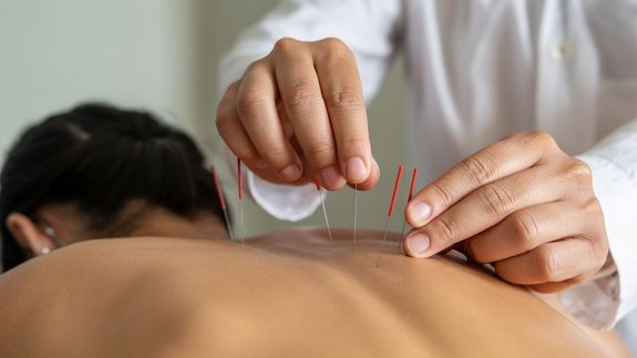 Close-Up Shot of a Person Doing an Acupuncture