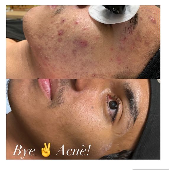 Acne Treatment