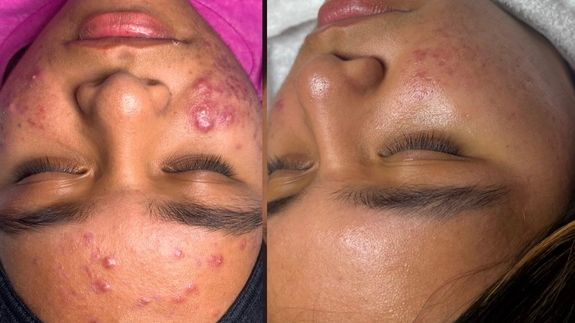 Don't let breakouts hold you back. Choose confidence instead.