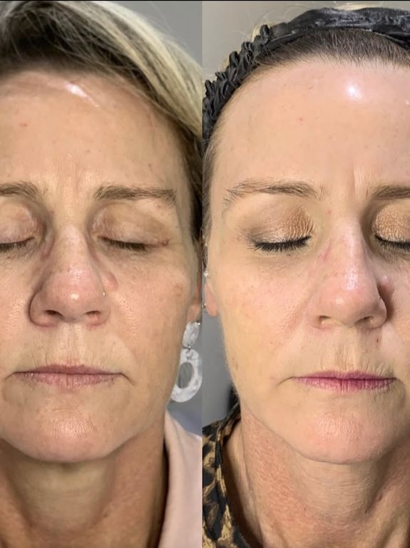 Instant, Natural-Looking Results