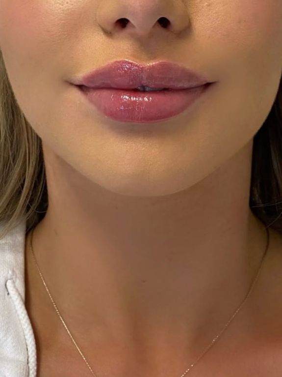 Lip Fillers: Natural Lip Augmentation for Fuller, Plump Lips