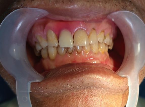Scaling/Pembersihan Karang Gigi