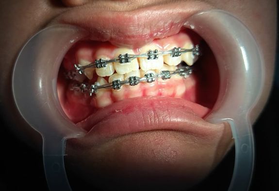 Merapikan Gigi/Behel Gigi