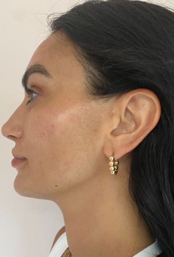 Reduces Fine Lines and Wrinkles