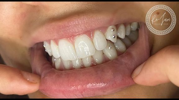 The Secret to a Sparkling, Confident Smile – Teeth Gems & Whitening at Rejuve Collective