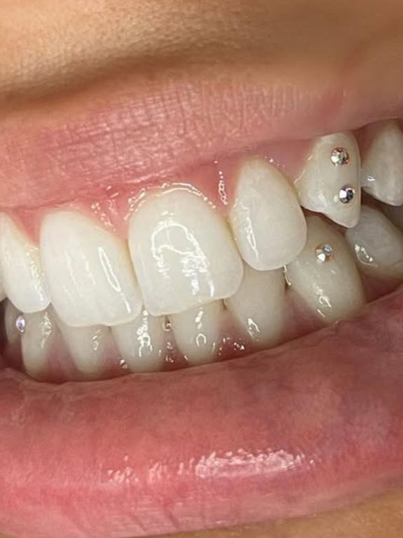 Instantly Brighter Smile