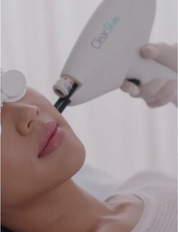 ClearSkin Pro™ Laser: Advanced Acne and Skin Rejuvenation Treatment