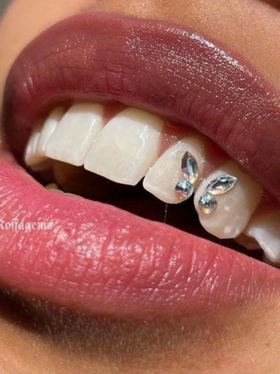 Teeth Gems and Whitening: Sparkle and Shine with Confidence