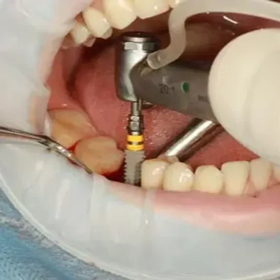 Implant Dentistry