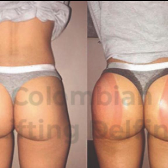 Columbian Butt Lift